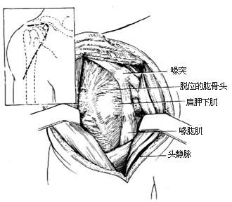 肩关节脱位切开复位术图片