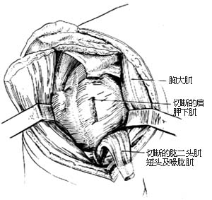 肩关节脱位切开复位术图片