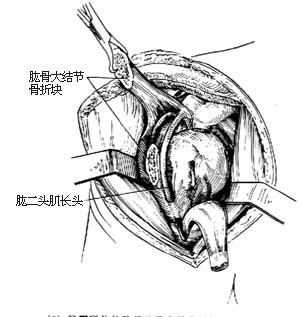 肩关节脱位切开复位术图片
