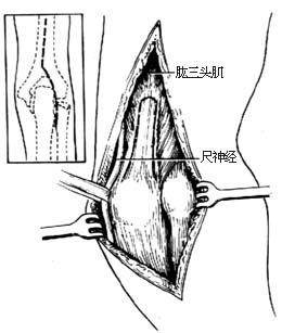肘关节脱位切开复位术图片