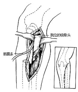 桡骨头脱位切开复位术图片
