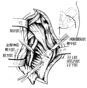 髋关节脱位切开复位术图片