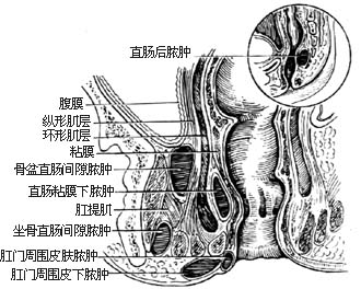 直肠肛管周围脓肿切开引流术图片