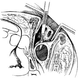直肠肛管周围脓肿切开引流术图片