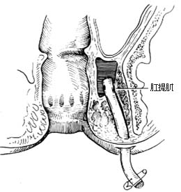 直肠肛管周围脓肿切开引流术图片