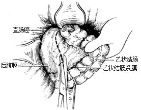 经腹、会阴直肠肛管根治切除术图片