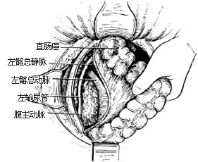 经腹、会阴直肠肛管根治切除术图片