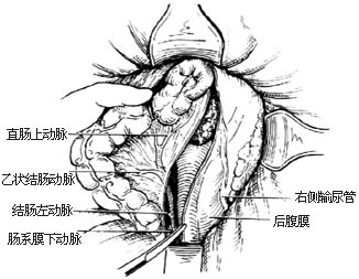 经腹、会阴直肠肛管根治切除术图片