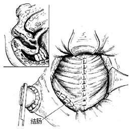 经腹、会阴直肠肛管根治切除术图片