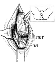 经腹、会阴直肠肛管根治切除术图片