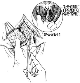 经腹、会阴直肠肛管根治切除术图片