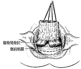 经腹、会阴直肠肛管根治切除术图片