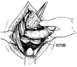 经腹、会阴直肠肛管根治切除术图片
