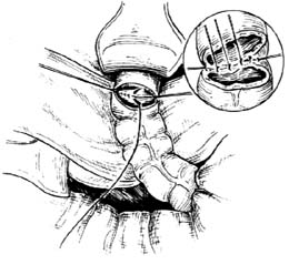 乙状结肠直肠切除端端吻合术图片