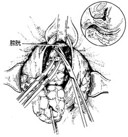 经腹、会阴直肠肛管根治切除术图片