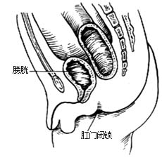 先天性直肠肛门畸形的手术图片