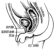 先天性直肠肛门畸形的手术图片