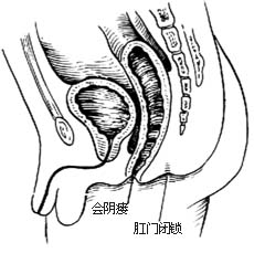 先天性直肠肛门畸形的手术图片