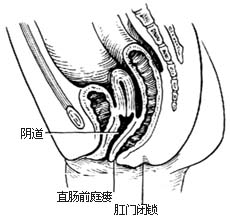 先天性直肠肛门畸形的手术图片