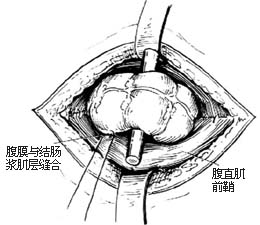 先天性直肠肛门畸形的手术图片