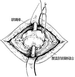 先天性直肠肛门畸形的手术图片