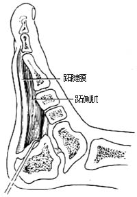 跖腱膜切断术图片