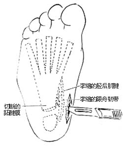 跖腱膜切断术图片