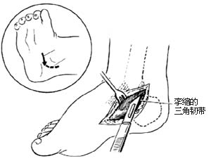 跖腱膜切断术图片