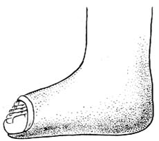 跖腱膜切断术图片