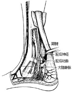 跟腱延长术图片