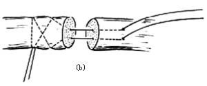 肌腱缝合术图片