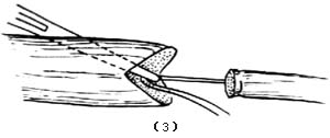 肌腱缝合术图片