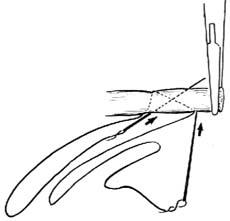 肌腱缝合术图片