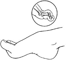 伸（足母） 长肌腱转移术图片