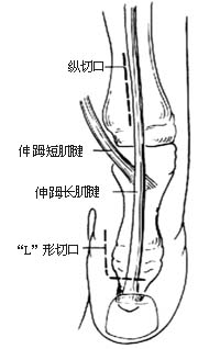 伸（足母） 长肌腱转移术图片