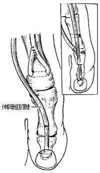 伸（足母） 长肌腱转移术图片