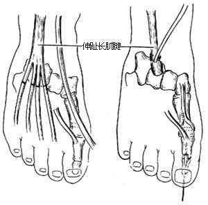 伸（足母） 长肌腱转移术图片