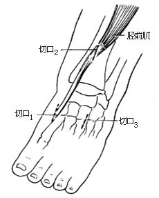 胫前肌腱转移术图片