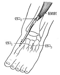 胫前肌腱转移术图片