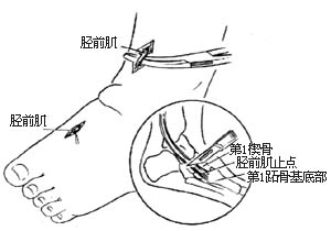 胫前肌腱转移术图片