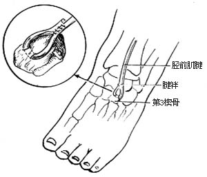 胫前肌腱转移术图片