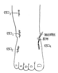 腓骨长肌腱转移术图片