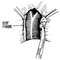 肺切除术图片