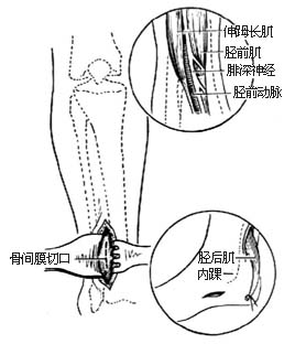 胫后肌腱转移术图片