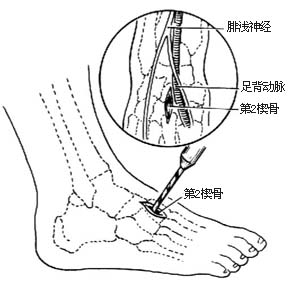 胫后肌腱转移术图片