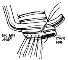 肺切除术图片