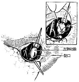 肺切除术图片