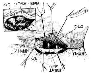 肺切除术图片