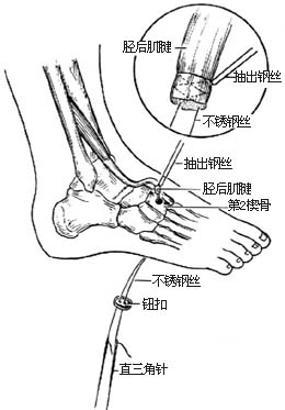 胫后肌腱转移术图片