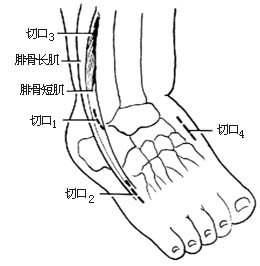 腓骨长肌腱转移术图片